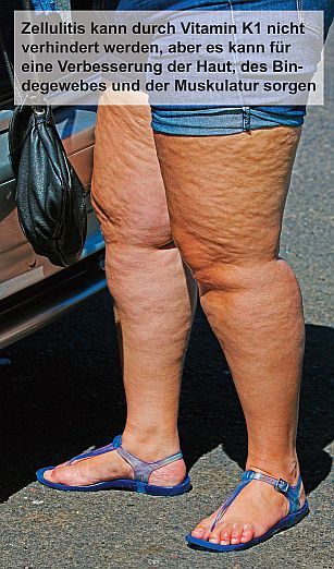 Zellulitis ist eine Entzündung des Unterhautzellgewebes